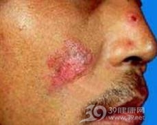 渗出性盘状苔藓样皮炎