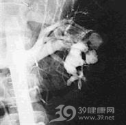 肾动静脉瘘