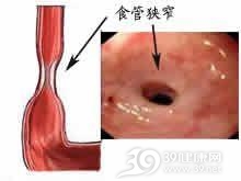 食管瘢痕性狭窄