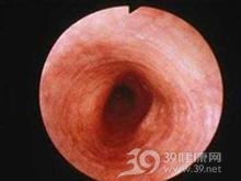 食管肉瘤