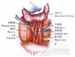 食管异位组织