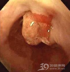 食管重复畸形