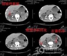 肾结核对侧肾积水