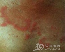 神经莱姆病