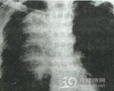 神经鞘源性肿瘤