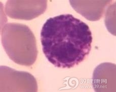 嗜碱性粒细胞增多症
