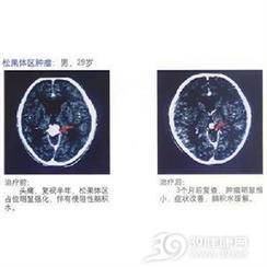 神经系统副肿瘤综合征