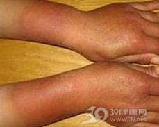 松节油皮炎