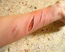 伤口肉毒症