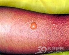 松毛虫皮炎