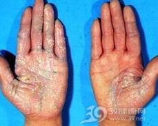 深脓疱病