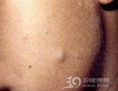 上皮样囊肿