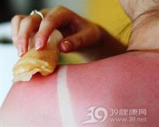 日光性皮炎