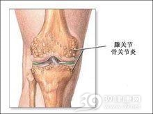 色素绒毛结节性滑膜炎