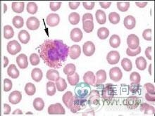 嗜酸细胞增多性复发性肉芽肿皮炎