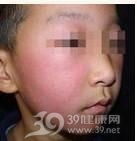 色素性化妆品皮炎