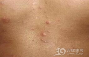 嗜酸性脓疱性毛囊炎