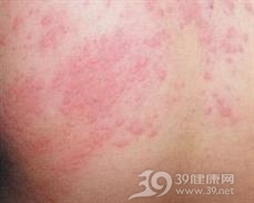 色素性荨麻疹