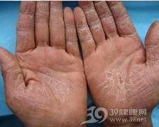 手湿疹