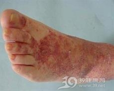 色素紫癜性皮炎