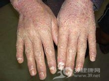 手癣