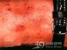 Ⅳ型超敏反应性疾病