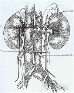 肾异位血管及副血管