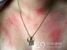 水源性荨麻疹