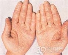 手足皲裂
