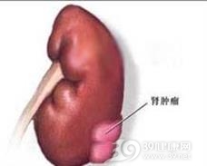 肾肿瘤