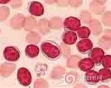 塞泽里综合征