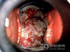 生殖器念珠菌病