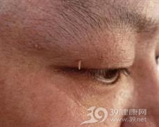 丝状疣