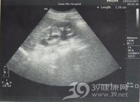 特发性腹膜后纤维化