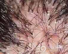 脱发性毛囊炎
