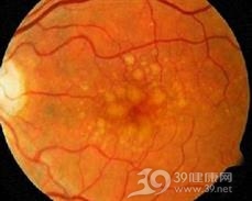 特发性息肉样脉络膜血管病变
