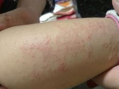 腿脚部湿疹