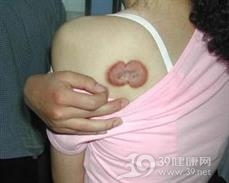 透明细胞汗腺腺瘤
