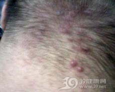 头皮毛囊炎