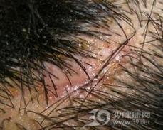 头皮脓疱糜烂性皮病