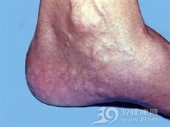 疼痛性脂肪疝