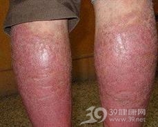 条纹状苔藓