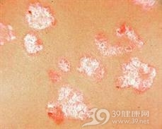 体癣