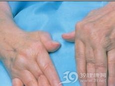 透析性骨关节病
