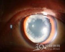 沃纳综合征