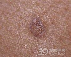 萎缩性毛周角化病