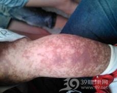 无色性色素失调症