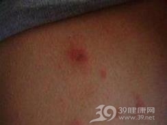 外源性光感性皮炎