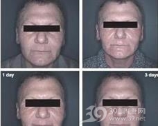 须部假毛囊炎