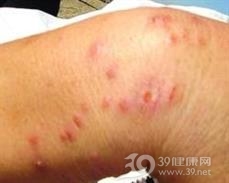 性病性淋巴肉芽肿